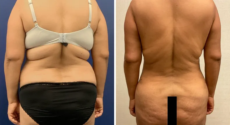 Before and after tummy tuck: patient's abdomen from the back, with liposuction