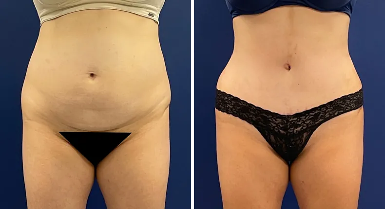 Before and after tummy tuck: patient's abdomen, with liposuction