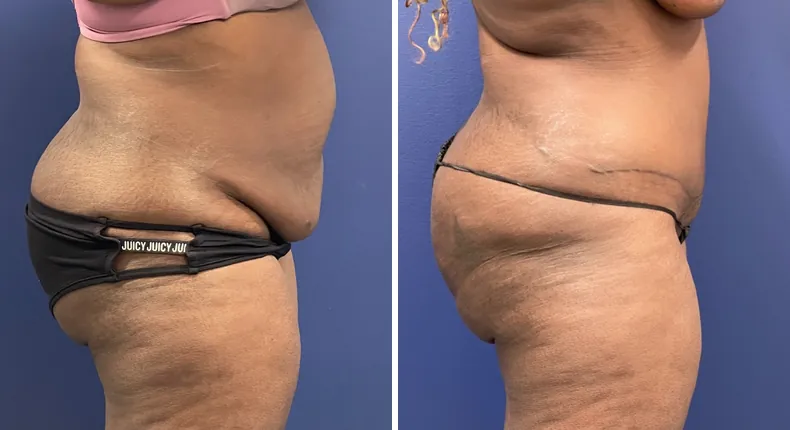 Before and after tummy tuck: patient's abdomen from the right side, with liposuction