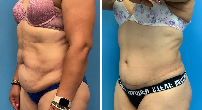 Before and after tummy tuck: patient's abdomen at a left angle
