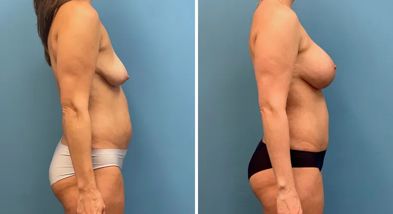 Before and after tummy tuck: patient's abdomen from the right side, with body lift, breast augmentation with lift and liposuction