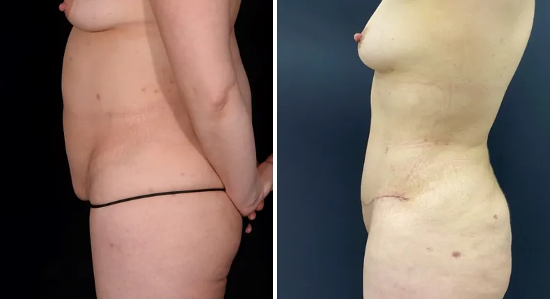 Before and after tummy tuck: patient's abdomen from the left side, with liposuction