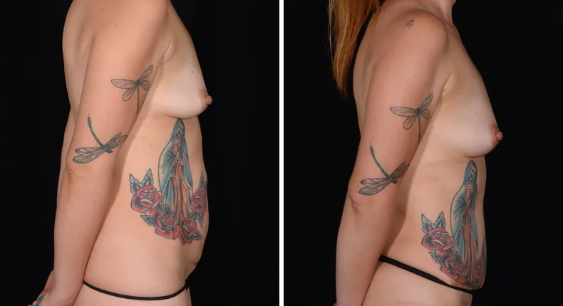 Before and after tummy tuck: patient's abdomen from the right side