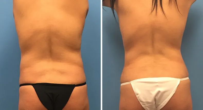 Before and after tummy tuck: woman's abdomen from the back, with liposuction