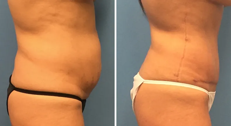 Before and after tummy tuck: woman's abdomen from the right side, with liposuction