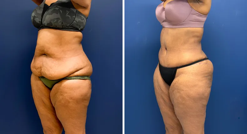 Before and after tummy tuck: patient's abdomen, with liposuction