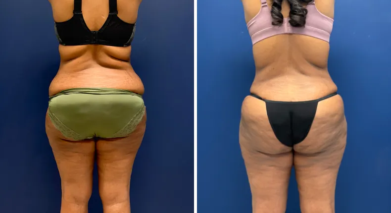 Before and after tummy tuck: patient's abdomen, with liposuction
