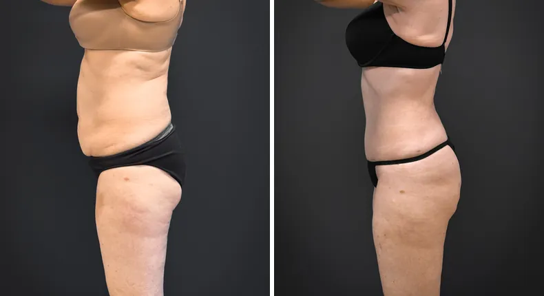 Before and after tummy tuck: patient's abdomen from the left side