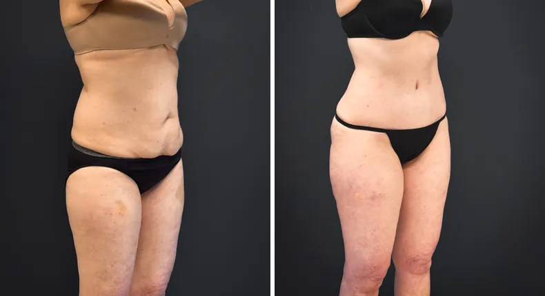 Before and after tummy tuck: patient's abdomen from the right side