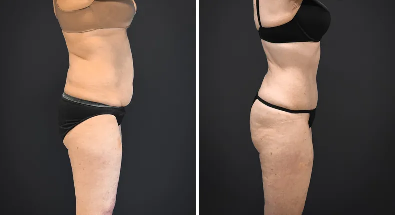 Before and after tummy tuck: patient's abdomen from the right side
