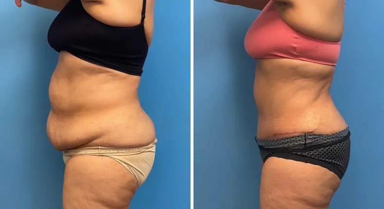 Before and after tummy tuck: patient's abdomen from the left side, with liposuction