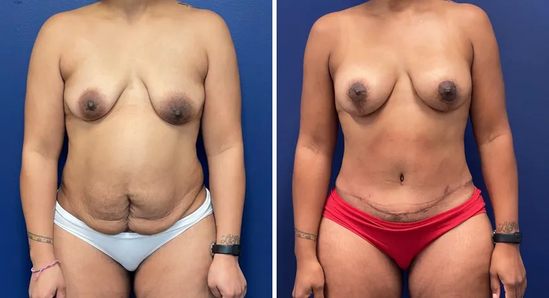 Before and after tummy tuck: woman's abdomen from the front, with breast augmentation, liposuction and mommy makeover