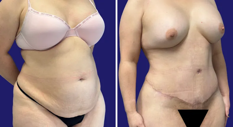 Before and after tummy tuck: woman's abdomen, with liposuction, mommy makeover and brazilian butt lift (bbl)