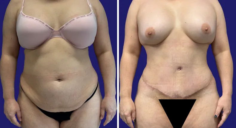 Before and after tummy tuck: woman's abdomen, with liposuction, mommy makeover and brazilian butt lift (bbl)