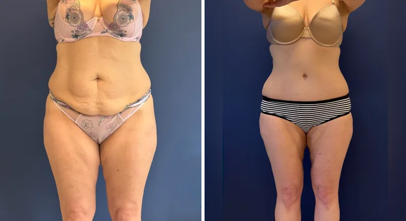 Before and after tummy tuck: patient's abdomen