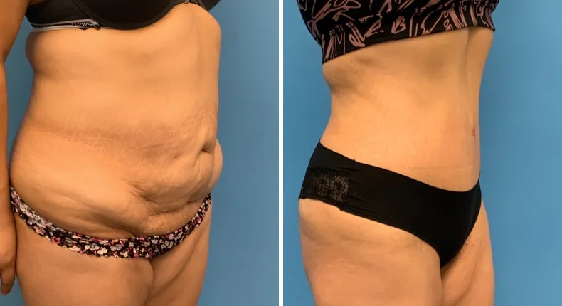 Before and after tummy tuck: patient's abdomen at a right angle