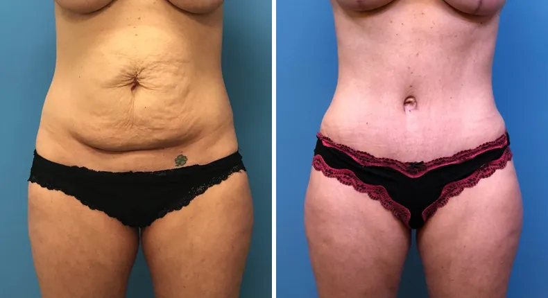 Before and after tummy tuck: woman's abdomen from the front, with liposuction