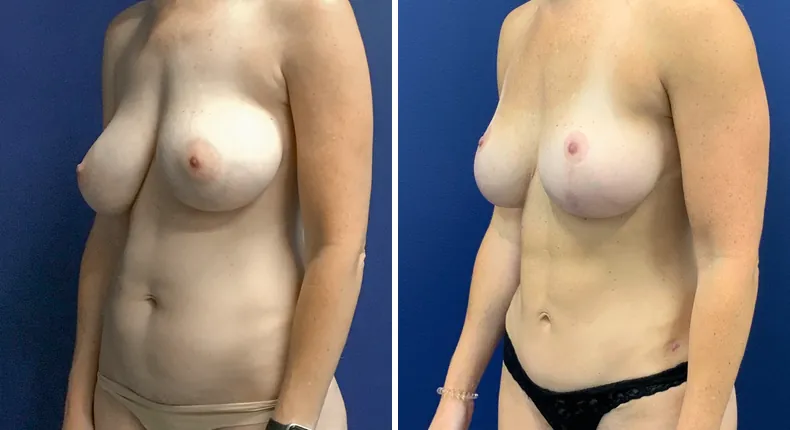 Before and after tummy tuck: patient's abdomen at a left angle, with revision breast augmentation