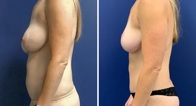 Before and after tummy tuck: patient's abdomen from the left side, with revision breast augmentation