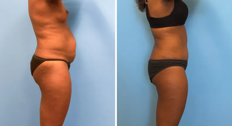 Before and after tummy tuck: patient's abdomen in right profile