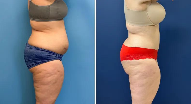Before and after tummy tuck: patient's abdomen from the right side