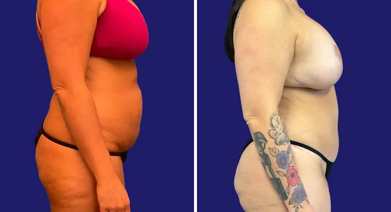 Before and after tummy tuck: woman's abdomen, with breast augmentation, breast lift, liposuction and mommy makeover