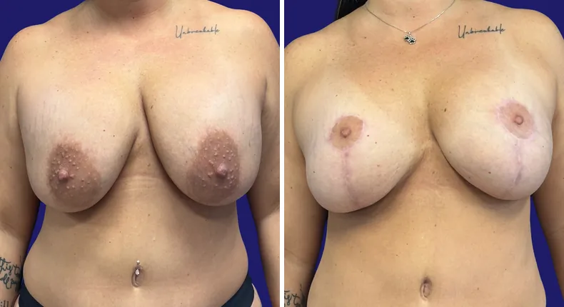 Before and after tummy tuck: woman's abdomen, with breast augmentation, breast lift, liposuction and mommy makeover