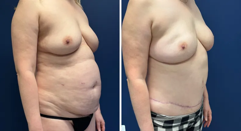 Before and after tummy tuck: woman's abdomen at a right angle, with liposuction and breast reconstruction