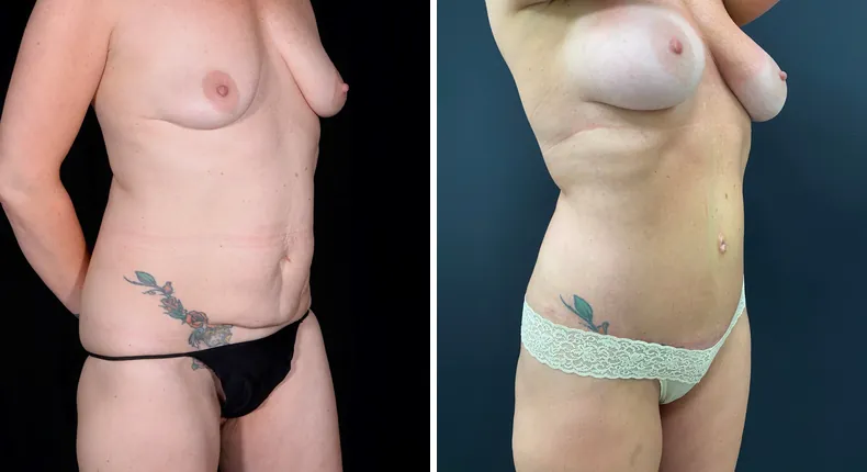 Before and after tummy tuck: patient's abdomen at a right angle, with breast augmentation