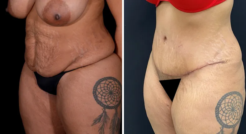 Before and after tummy tuck: woman's abdomen at a left angle, with liposuction