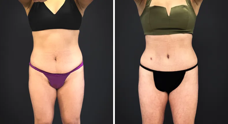 Before and after tummy tuck: patient's abdomen from the front