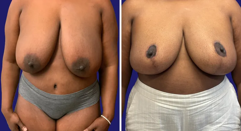 Before and after tummy tuck: woman's abdomen, with breast reduction and liposuction