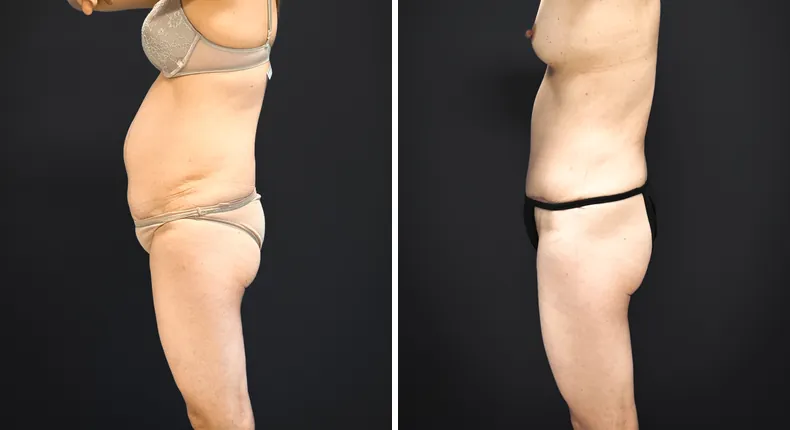 Before and after tummy tuck: patient's abdomen from the left side