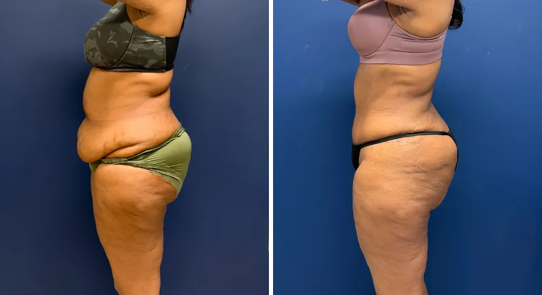 Before and after tummy tuck: patient's abdomen, with liposuction