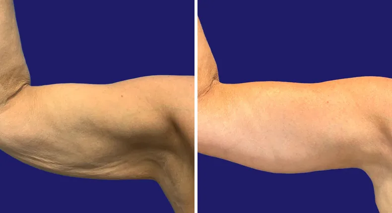 Before and after tummy tuck: woman's abdomen, with breast augmentation, breast lift, liposuction, mommy makeover and arm lift