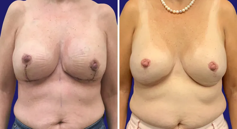 Before and after tummy tuck: patient's abdomen, with breast reconstruction and liposuction