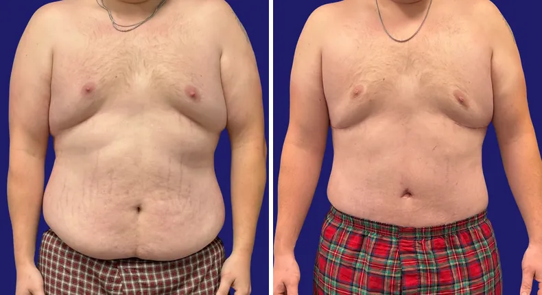 Before and after tummy tuck: man's abdomen from the front, with liposuction