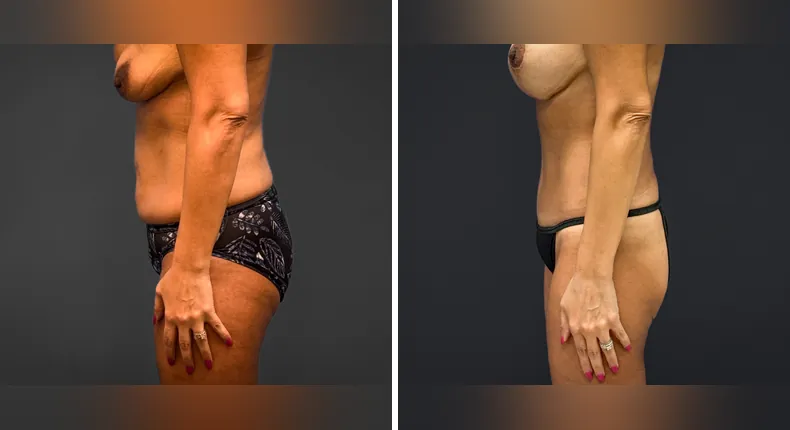 Before and after tummy tuck: patient's abdomen from the left side, with liposuction