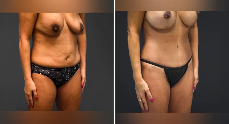 Before and after tummy tuck: patient's abdomen from the right side, with liposuction