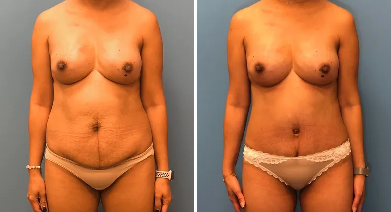 Before and after tummy tuck: woman's abdomen from the front, with breast reconstruction