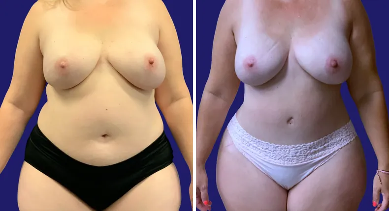Before and after tummy tuck: woman's abdomen from the front, with breast reconstruction, liposuction and mommy makeover