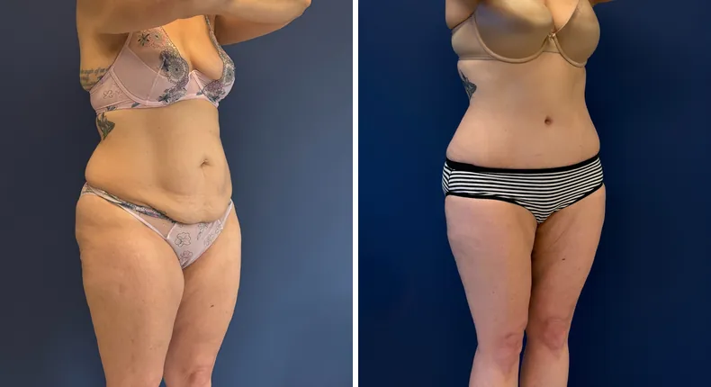 Before and after tummy tuck: patient's abdomen