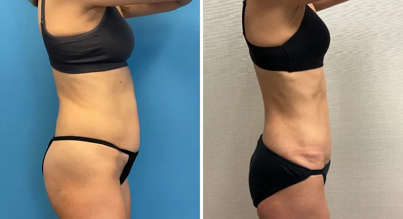 Before and after tummy tuck: patient's abdomen from the right side