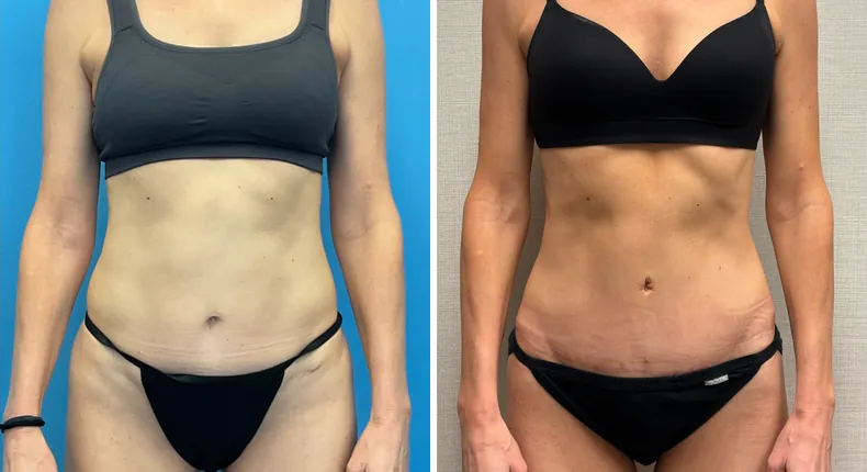 Before and after tummy tuck: patient's abdomen from the front