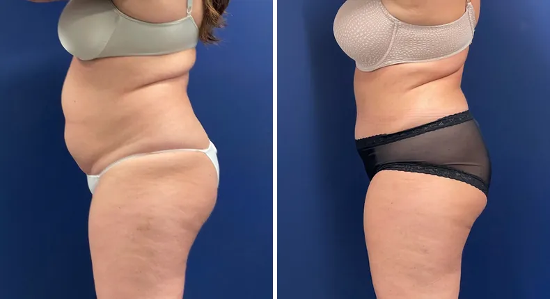 Before and after tummy tuck: patient's abdomen in left profile