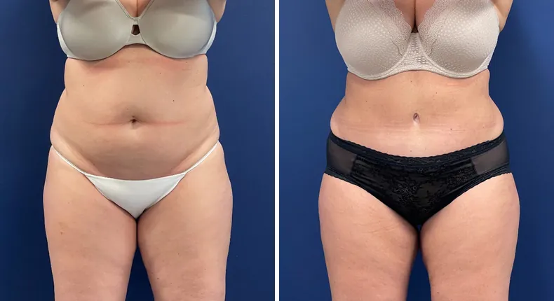Before and after tummy tuck: patient's abdomen from the front
