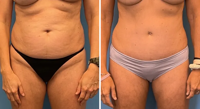 Before and after tummy tuck: patient's abdomen from the front, with liposuction