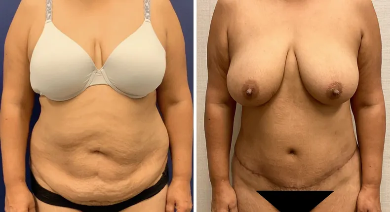 Before and after tummy tuck: patient's abdomen from the front, with liposuction