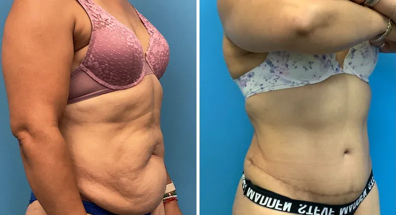 Before and after tummy tuck: patient's abdomen at a right angle