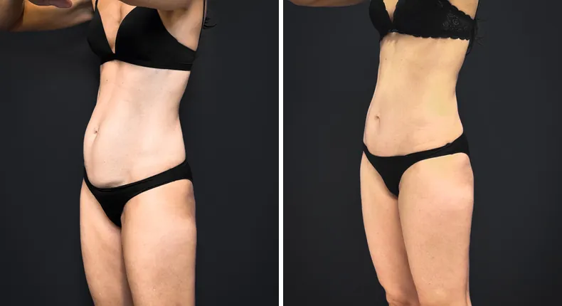 Before and after tummy tuck: patient's abdomen from the left side